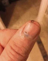 약 혐 ] 손톱에 난 피멍이 사라지는 모습.gif