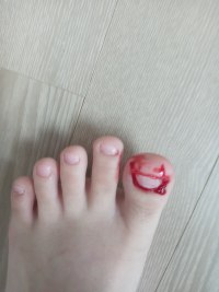 blood from my foot