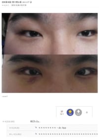 남자 눈 성형 레전드.jpg