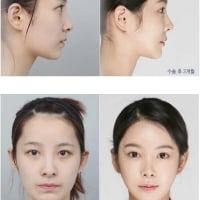 사람들이 너무 안타까워한 성형외과 비포애프터 사진.jpg